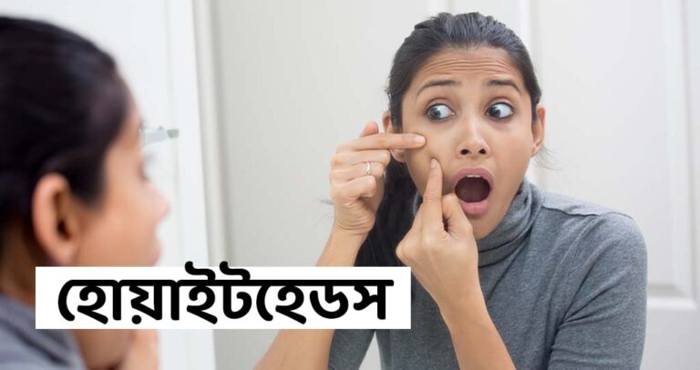 হোয়াইটহেডসের কারণ